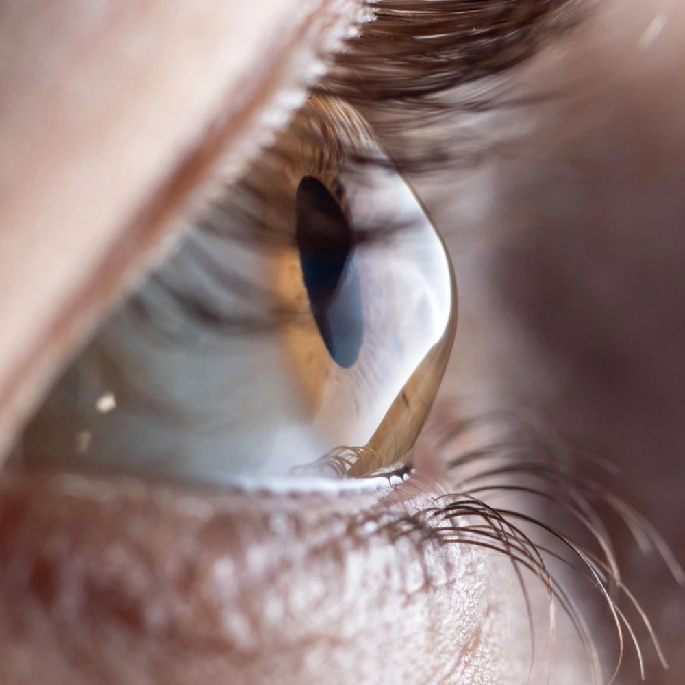 close of of an eye with Keratoconus