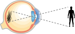 myopia illustration