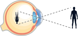 astigmatism illustration